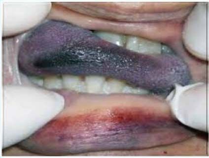 Причины гипертрофии половых губ